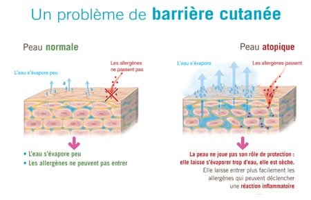 eczema probleme barriere cutanee